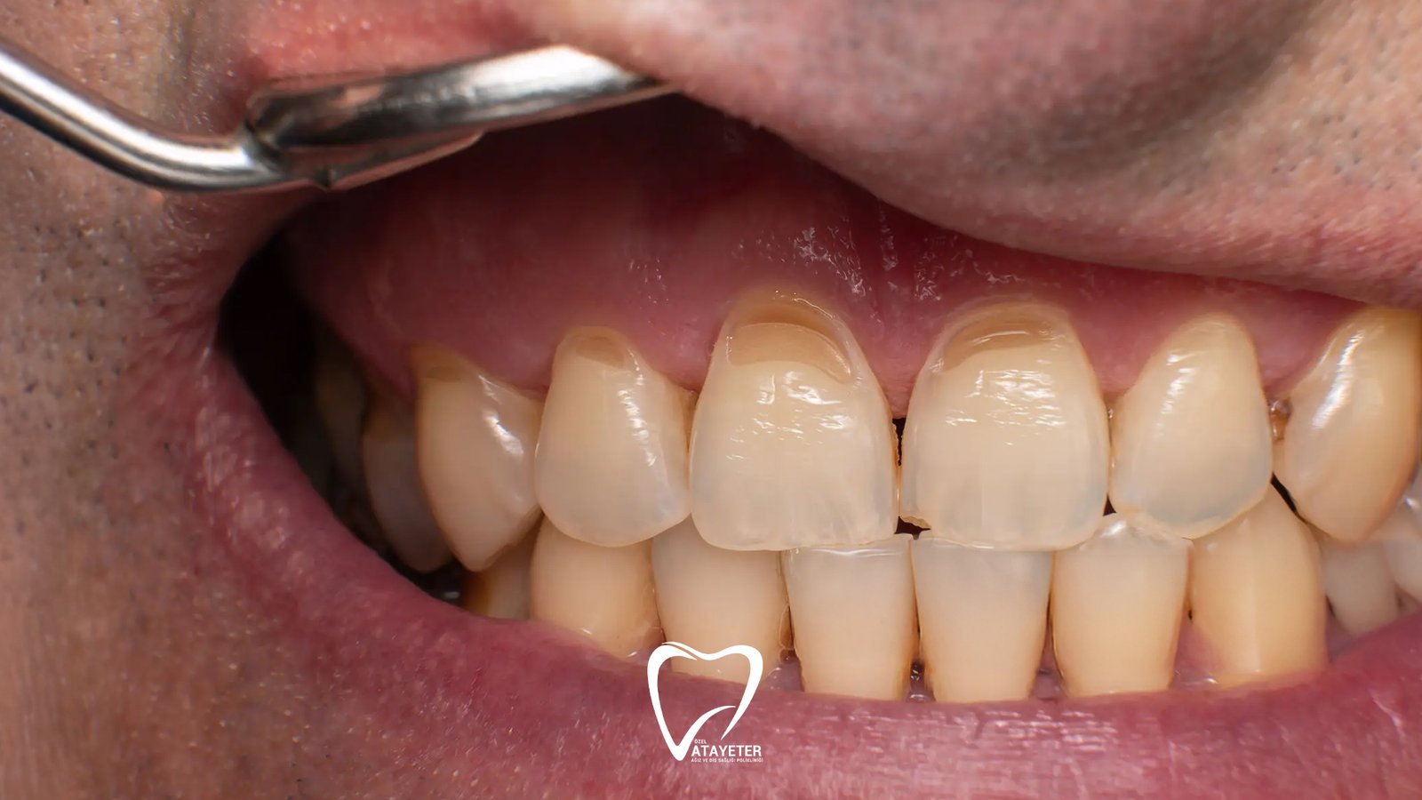What is Tooth Erosion