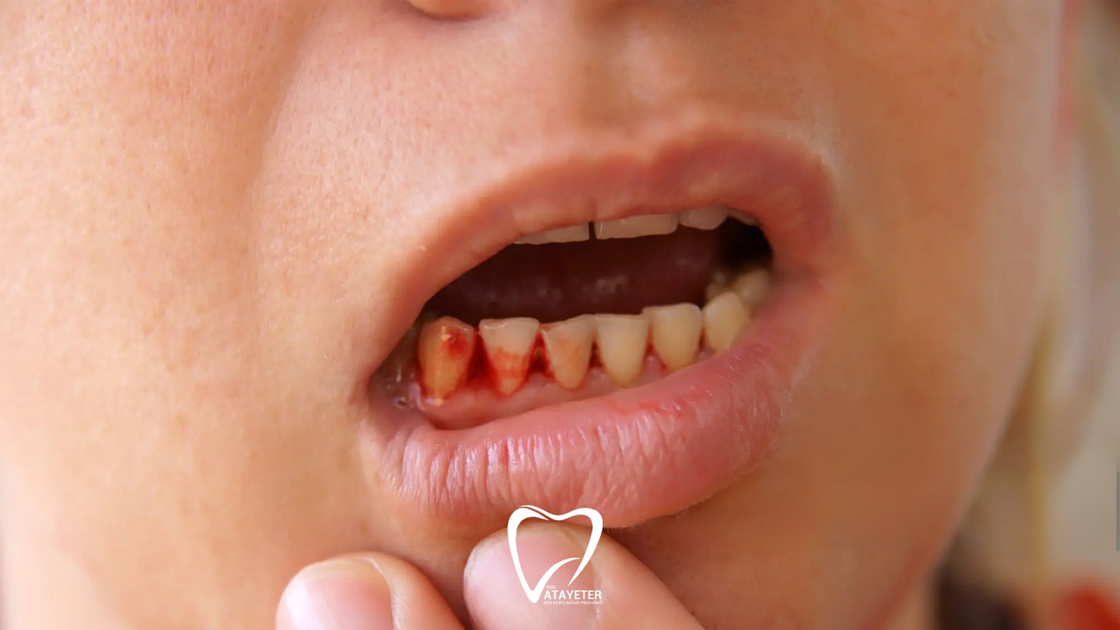 Causes of Gum Bleeding