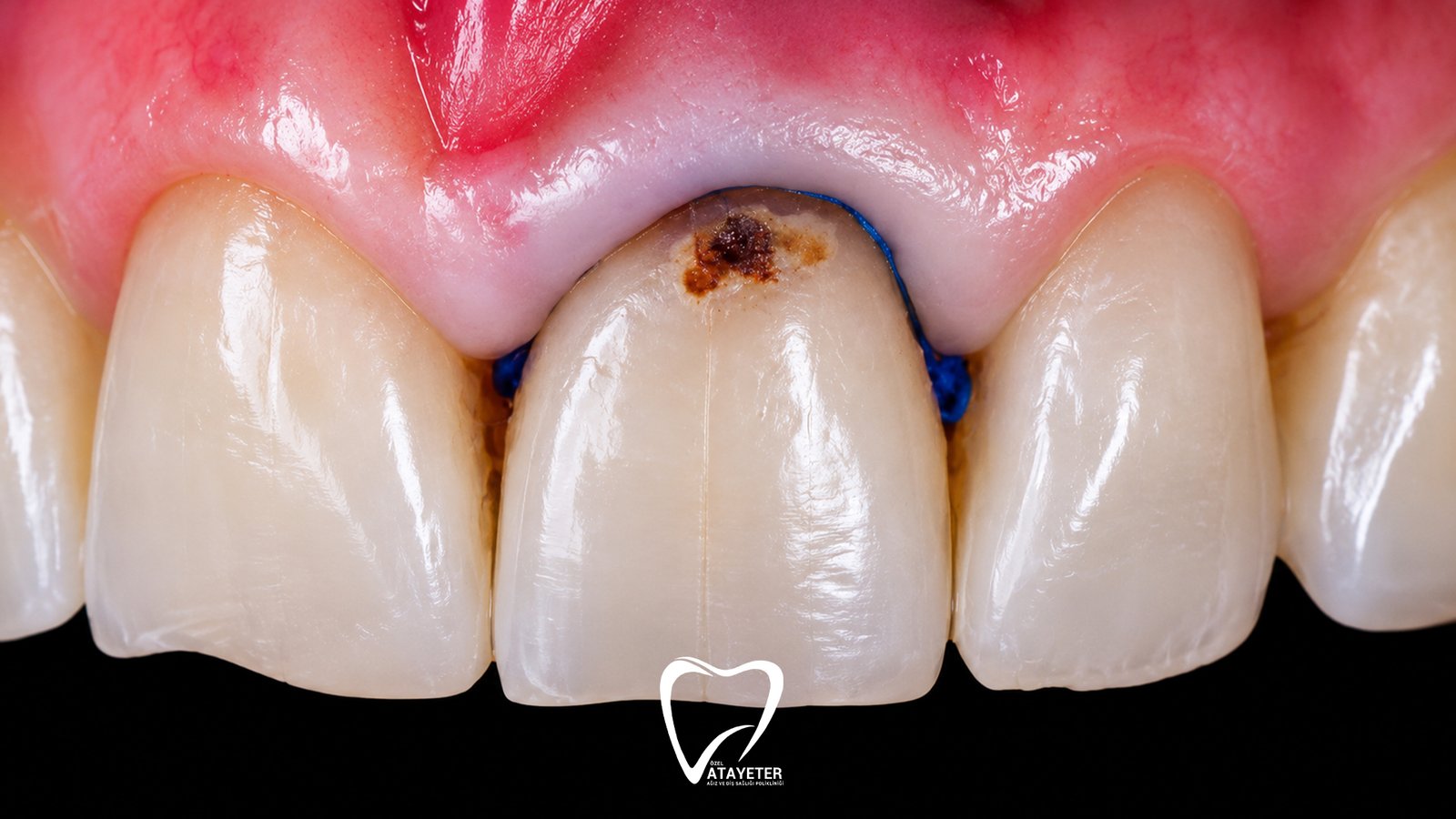 What Is a Dental Lesion