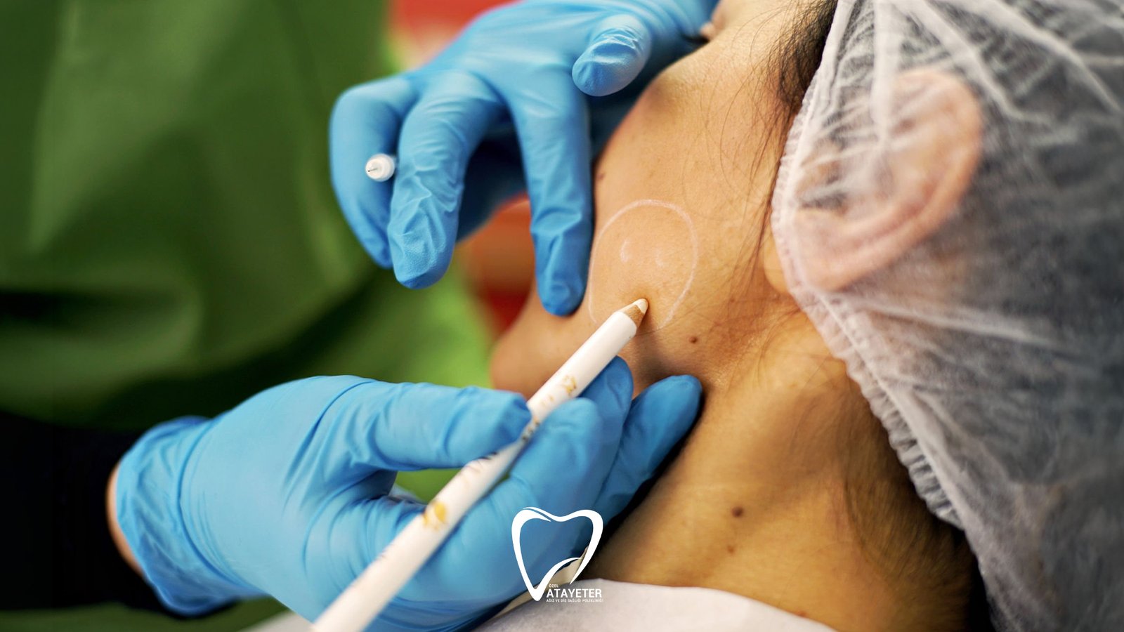 Masseter Botoks Nedir