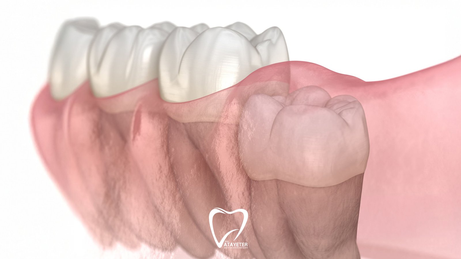 How to Relieve Wisdom Tooth Pain