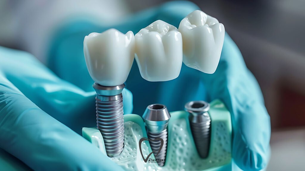 İmplant Tedavisi
