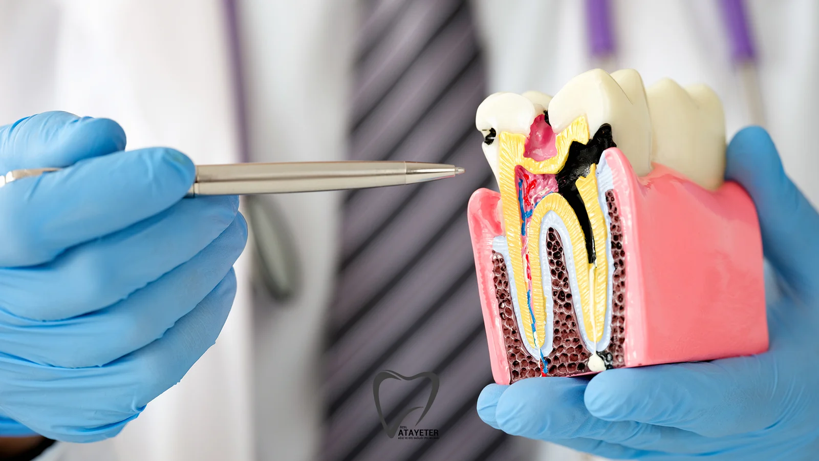 Root Canal Treatment