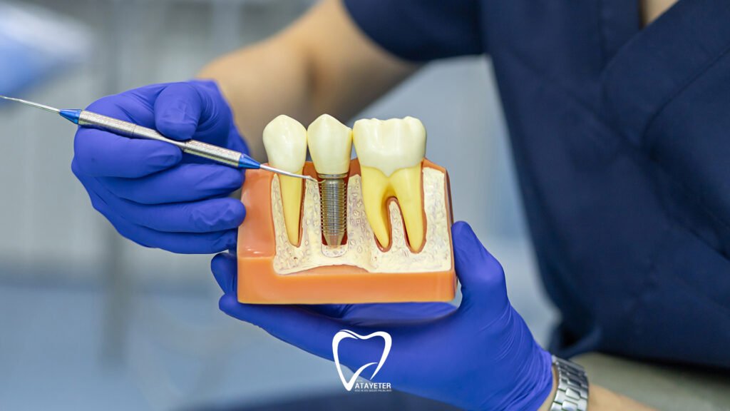 Dental Implant Treatment