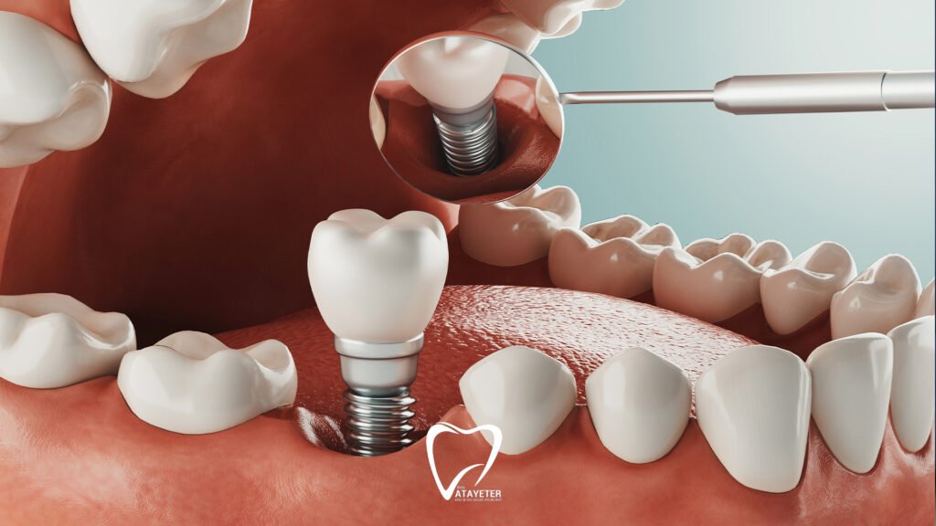 Dental Implant Treatment