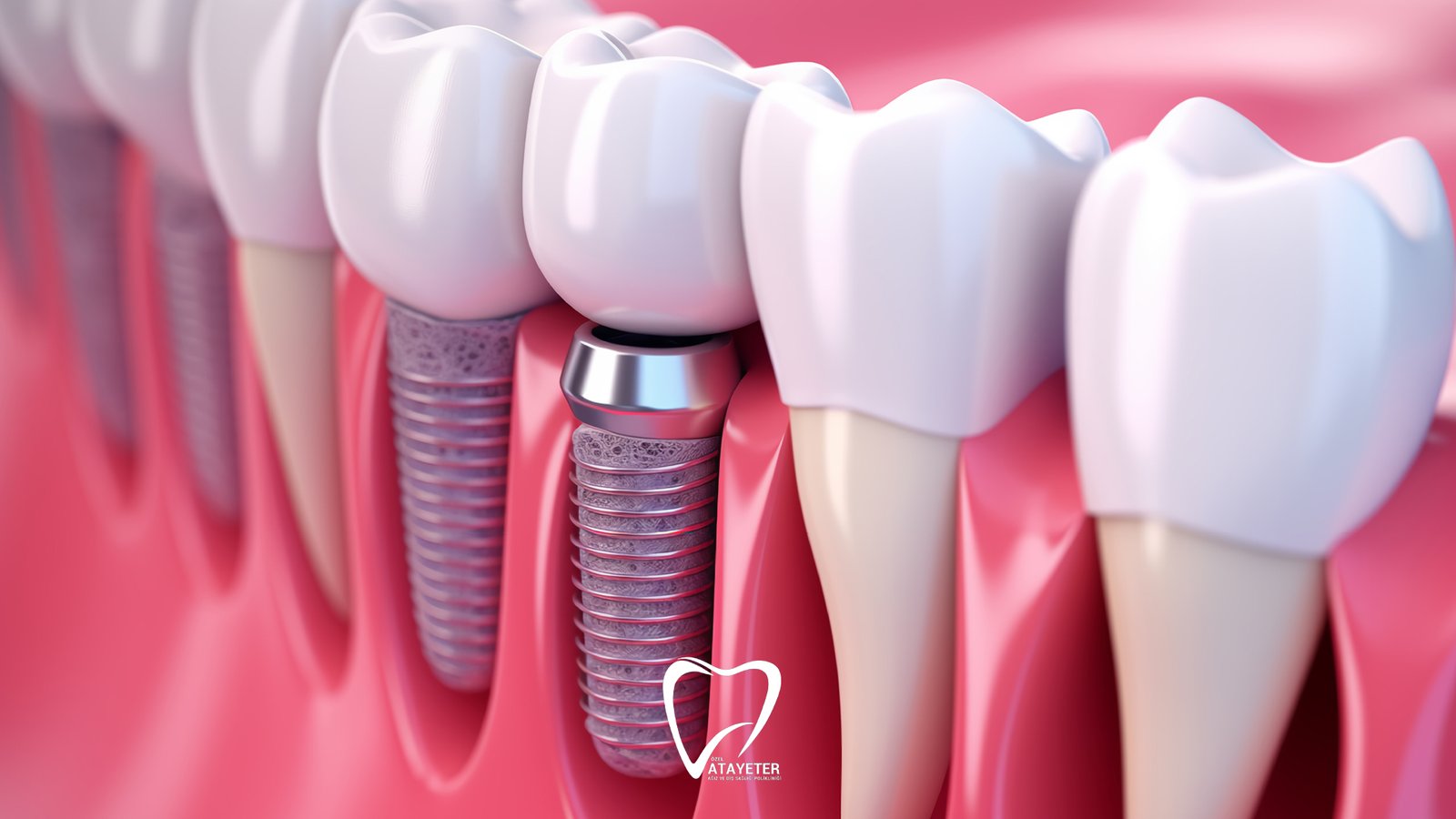 İmplant Diş Tedavisi