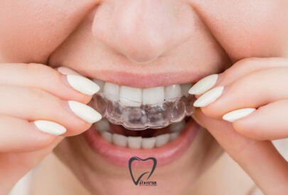 Şeffaf Plak Tedavisi