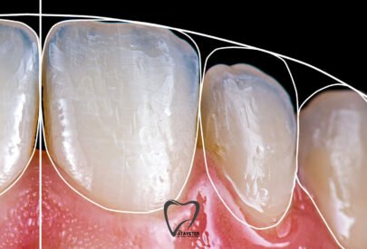 Gülüş Tasarımı Nedir