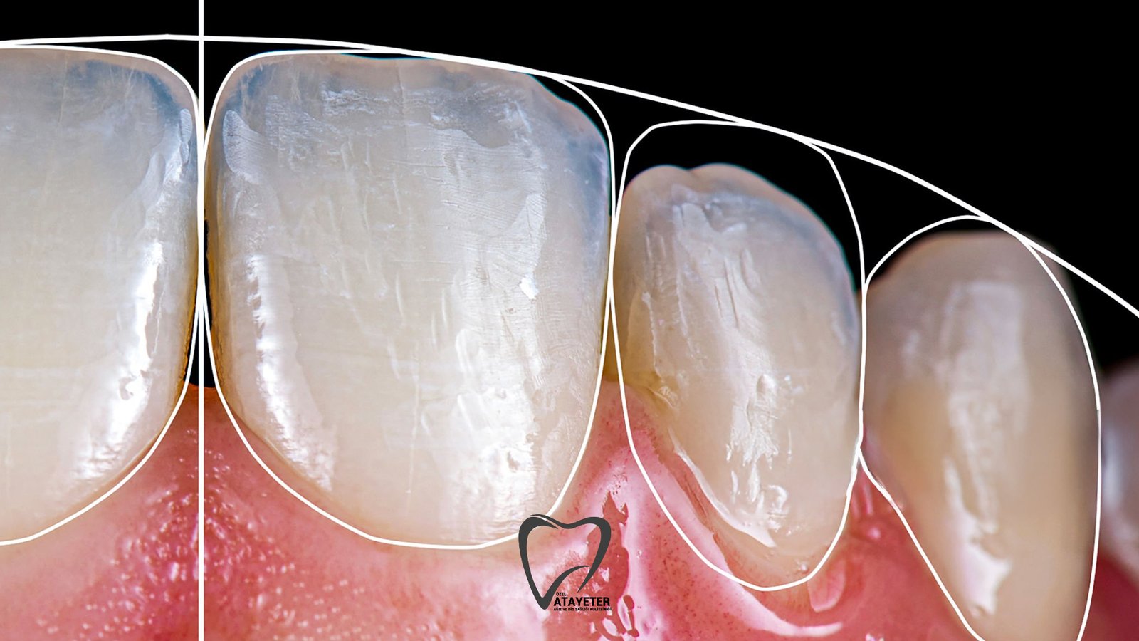 Gülüş Tasarımı Nedir