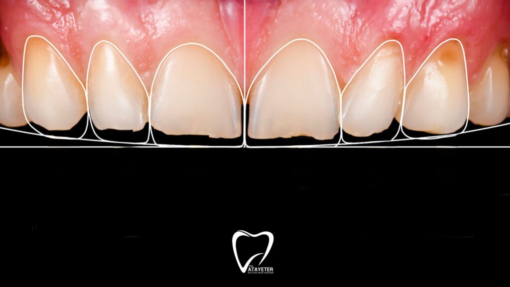 What is Hollywood Smile