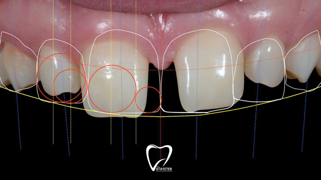 What is Hollywood Smile
