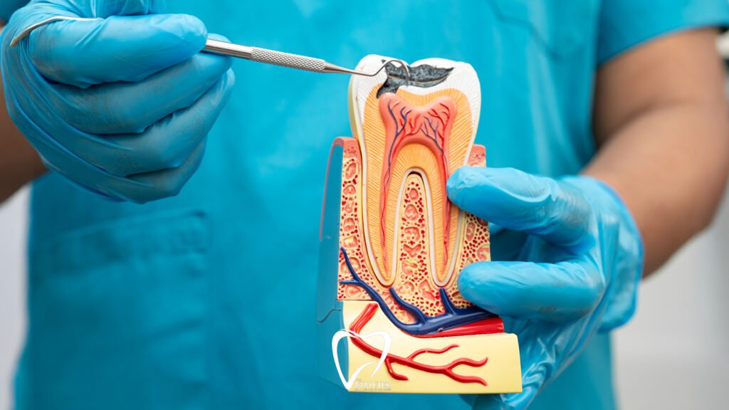 Pain After Root Canal Treatment