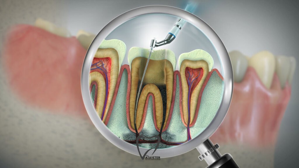 Pain After Root Canal Treatment