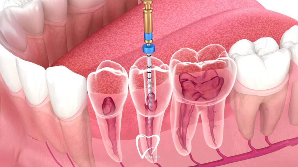 Pain After Root Canal Treatment