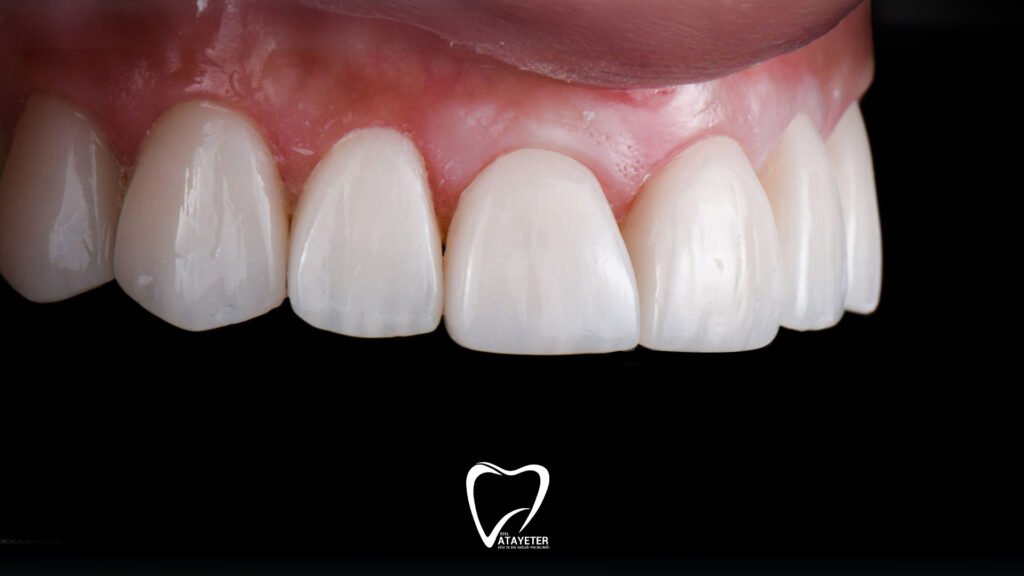 What is a Zirconium Crown