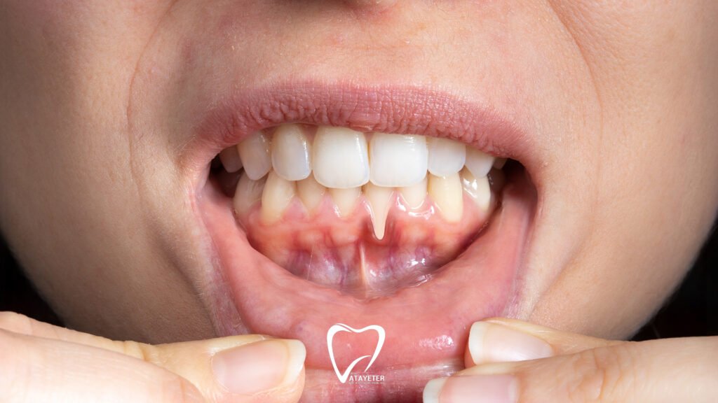 What is gum recession