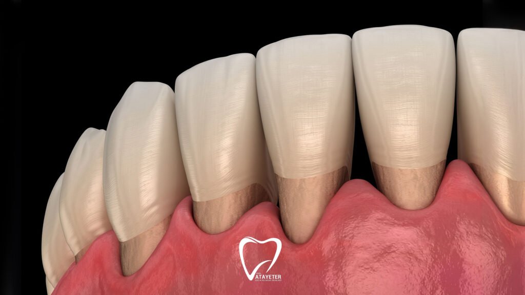 What is gum recession