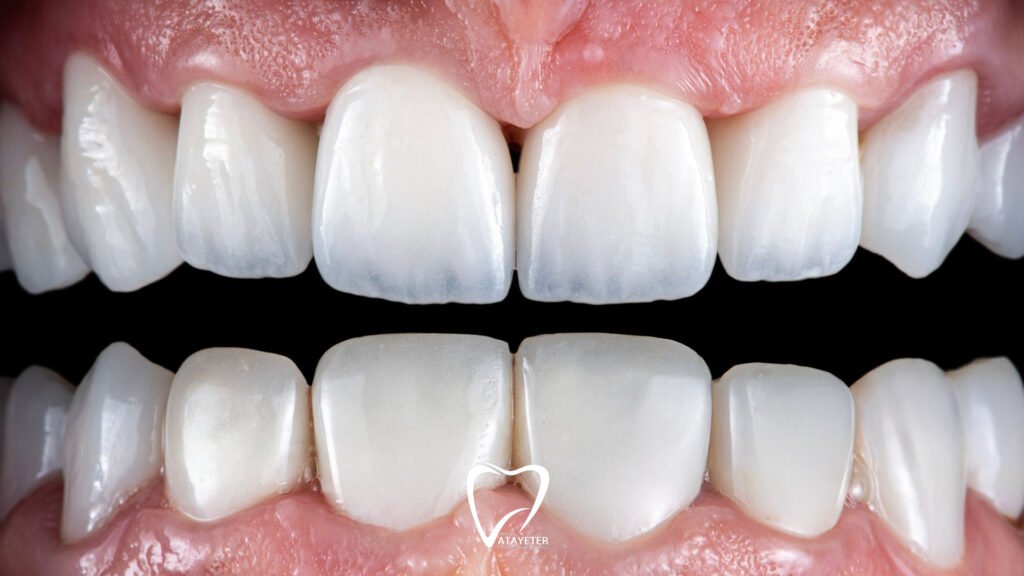 What is a Zirconium Crown