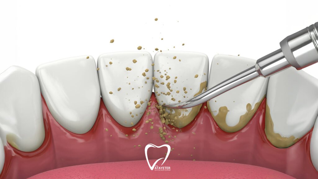 Is Dental Tartar Cleaning Harmful