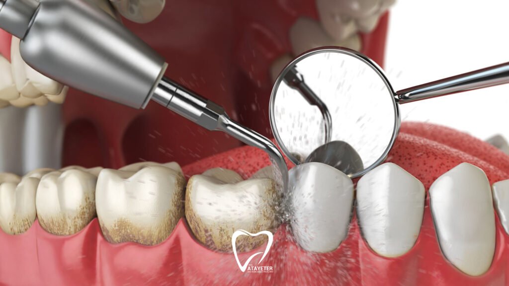 Is Dental Tartar Cleaning Harmful