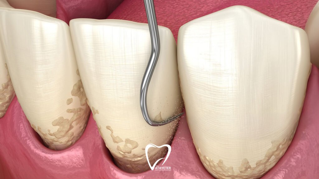 Is Dental Tartar Cleaning Harmful