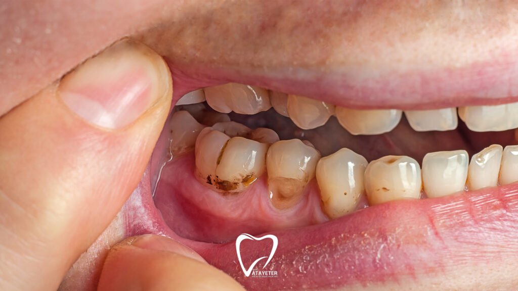 Diş Ağrısına Ne İyi Gelir