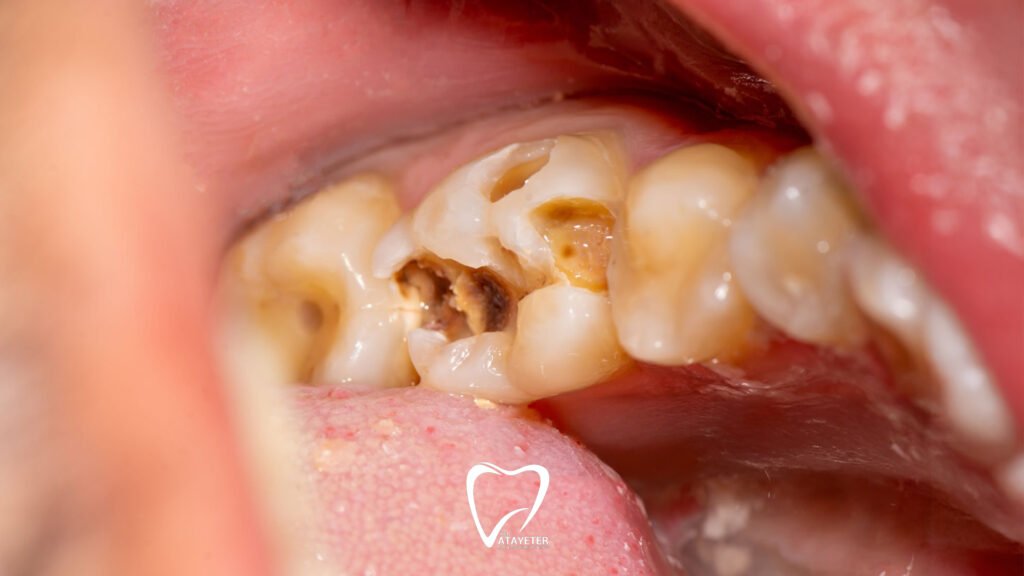 Diş Ağrısına Ne İyi Gelir