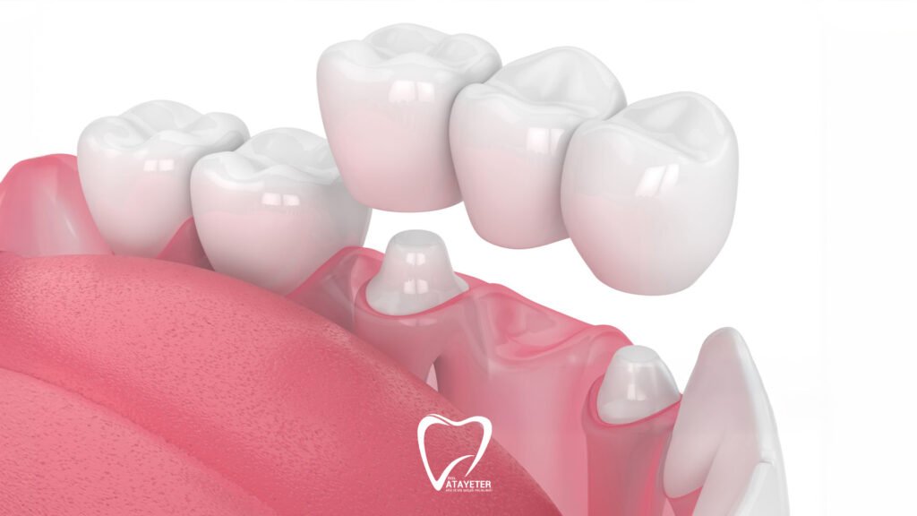 What Is a Dental Bridge