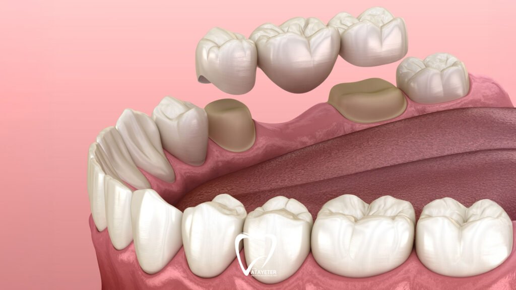 What Is a Dental Bridge