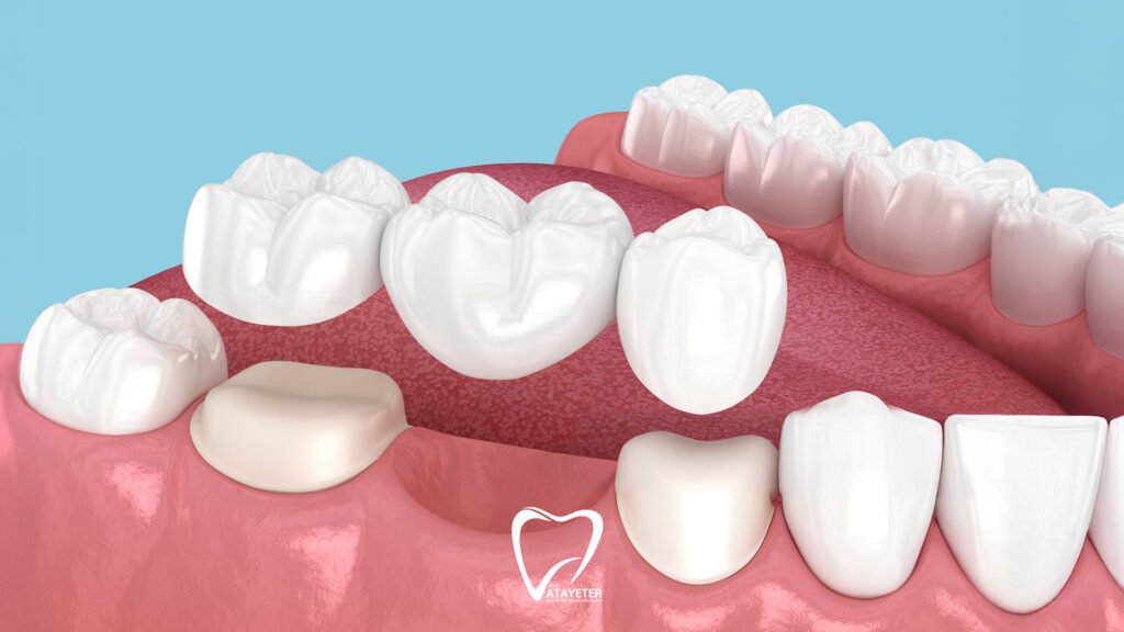 What Is a Dental Bridge