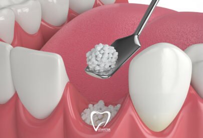 Kemik Tozu Tedavisi Nedir