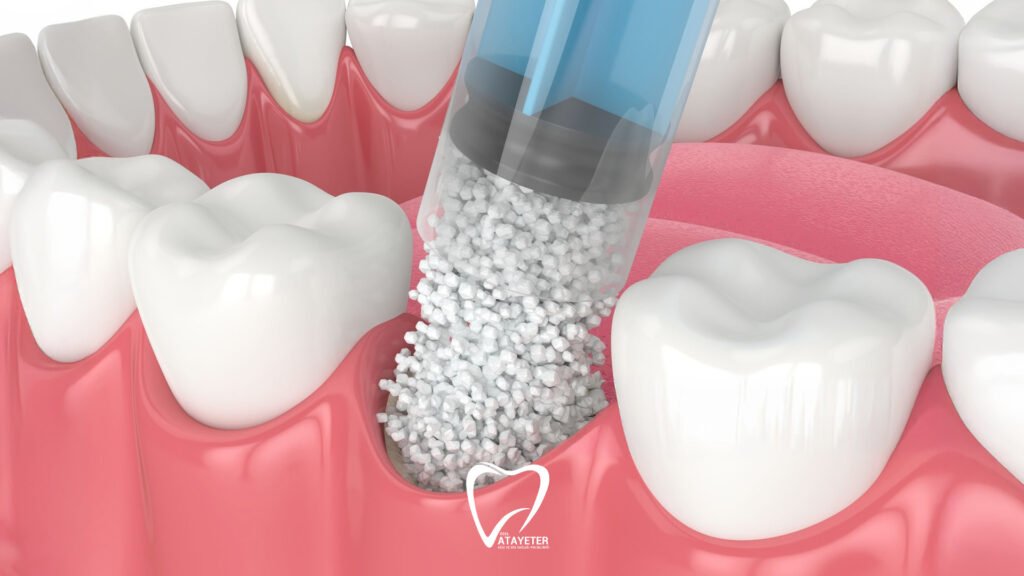 What Is Bone Grafting Treatment