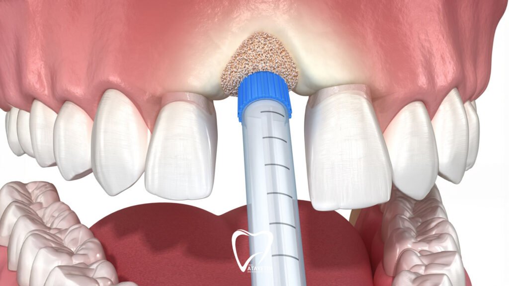 What Is Bone Grafting Treatment