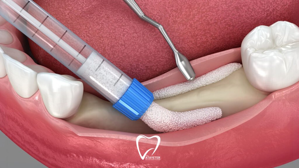 What Is Bone Grafting Treatment