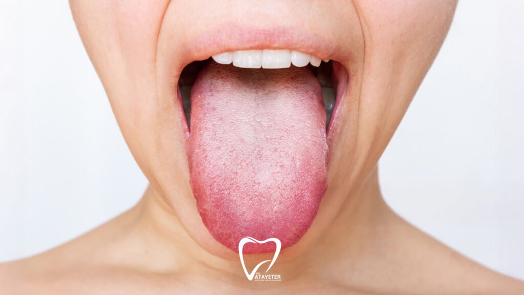 Ağız Kuruluğu Neden Olur
