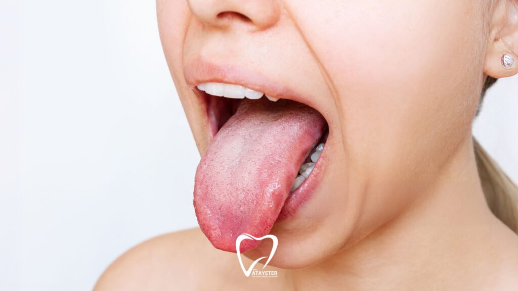What Causes Dry Mouth
