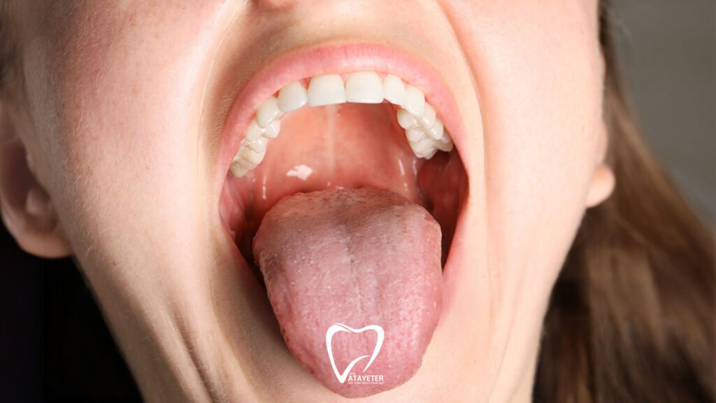 Ağız Kuruluğu Neden Olur