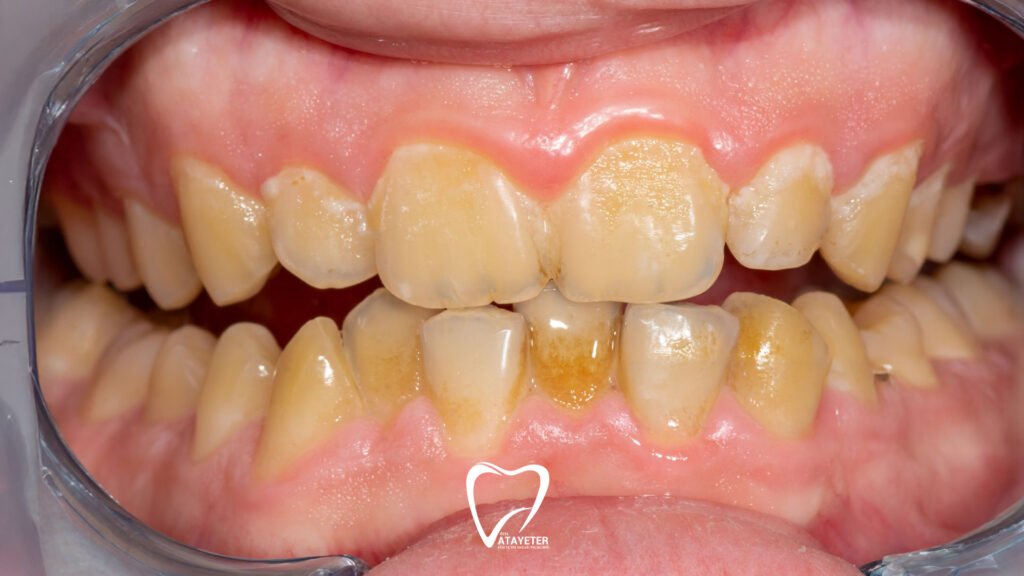 Causes of Tooth Discoloration