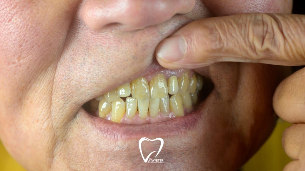 Causes of Tooth Discoloration