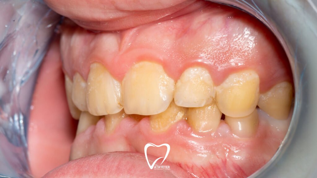 Causes of Tooth Discoloration