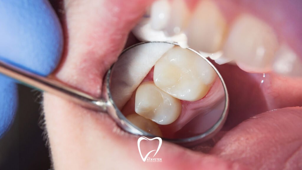 What Is Composite Filling