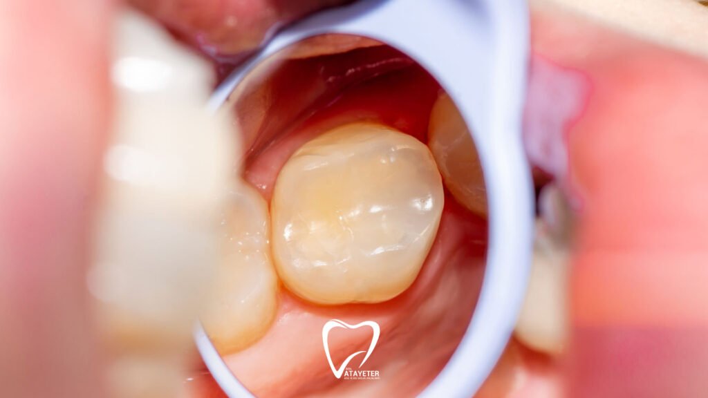 What Is Composite Filling