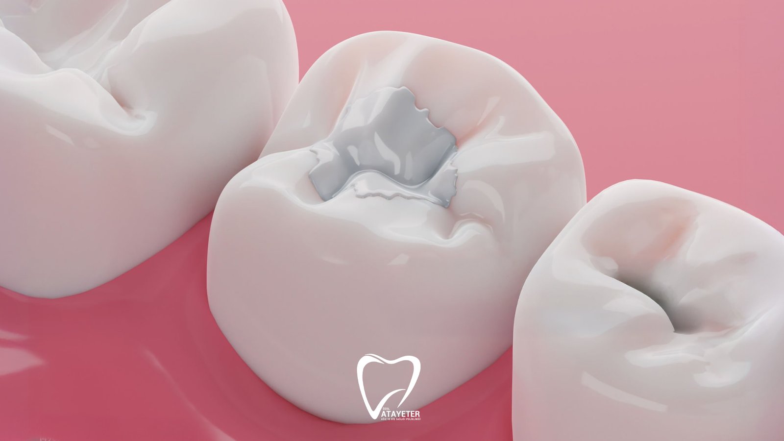 Kompozit Dolgu Nedir