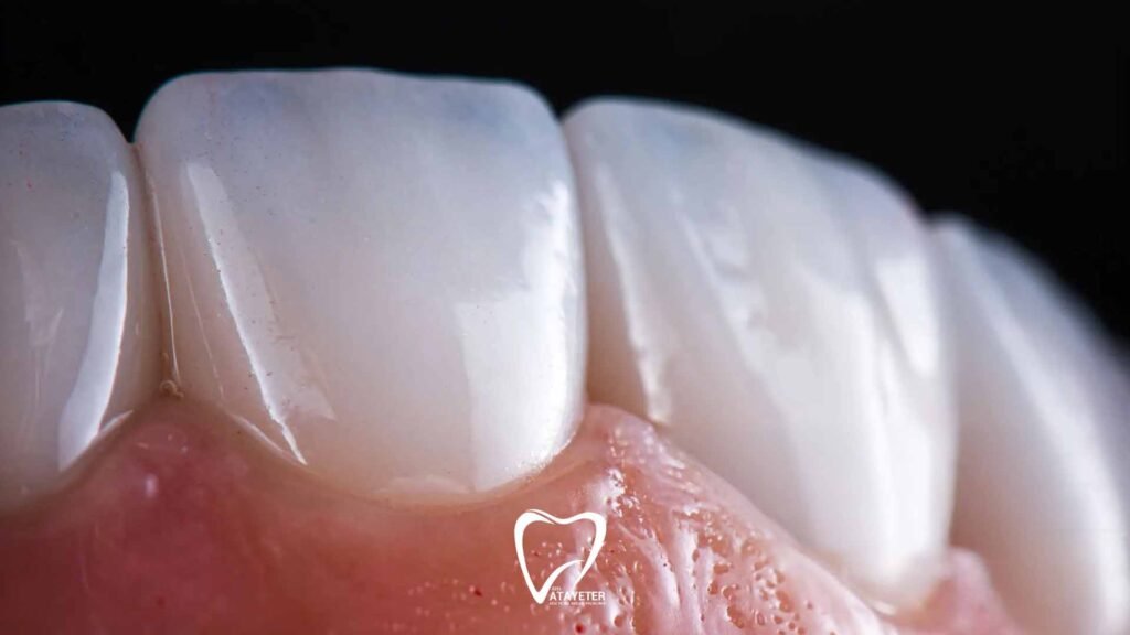 Zirkonyum ve Lamine Arasındaki Farklar