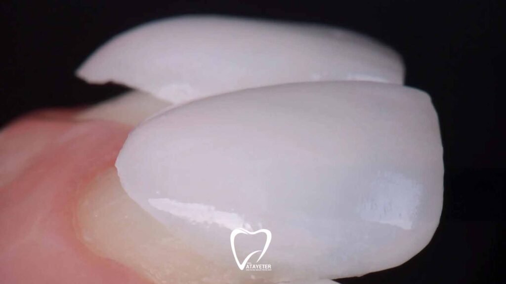 Differences Between Zirconia and Veneers