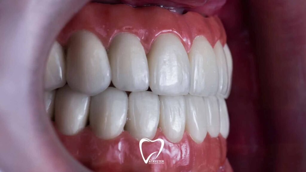 Differences Between Zirconia and Veneers