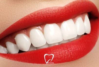 Zirkonyum ve Lamine Arasındaki Farklar