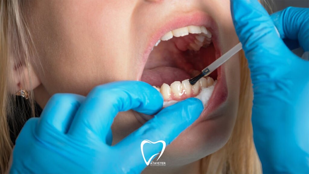 What is Fluoride Treatment