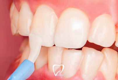 Florür Tedavisi Nedir