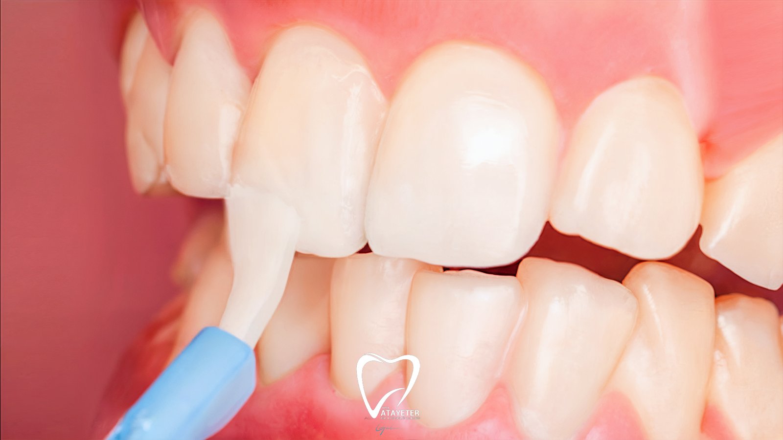 Florür Tedavisi Nedir